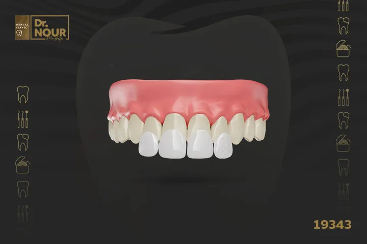 التيجان التجميلية للاسنان