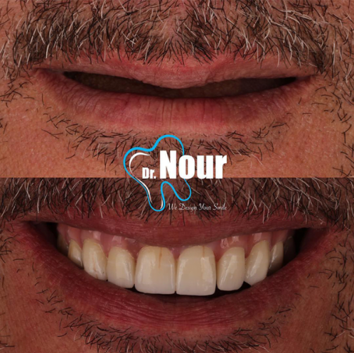 تجربتي مع زرع الأسنان قبل وبعد مع مركز وايتي