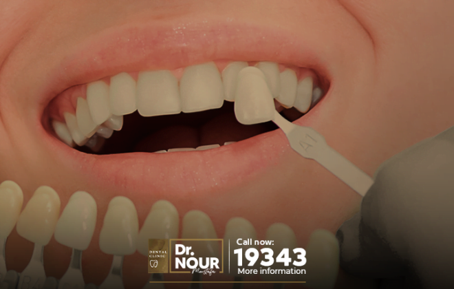 تعرف على الفرق بين زراعة الاسنان وتركيب الاسنان