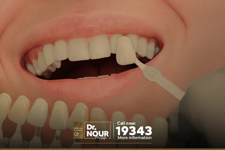 تعرف على الفرق بين زراعة الاسنان وتركيب الاسنان