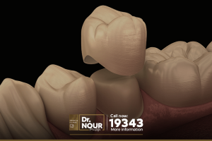 افضل انواع تركيبات الاسنان الثابتة واسعارها في مصر