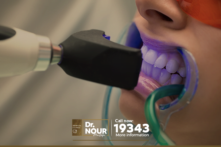 تبييض الاسنان بالليزر لا يمكن ان يتم في تلك الحالات