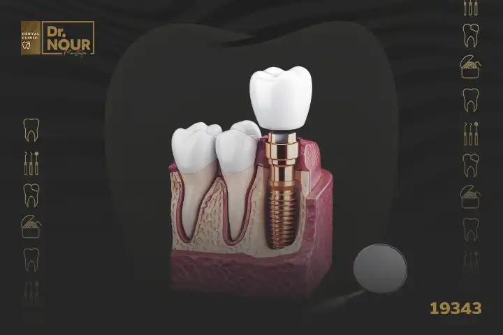 افضل مراكز زراعة الاسنان فى مصر