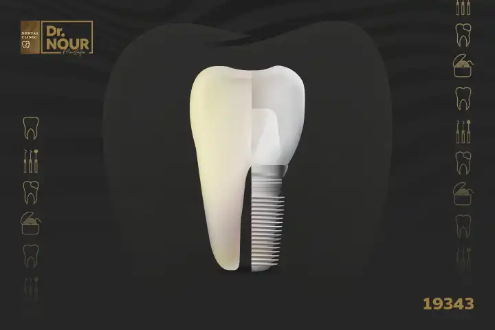 زراعة الاسنان قبل وبعد