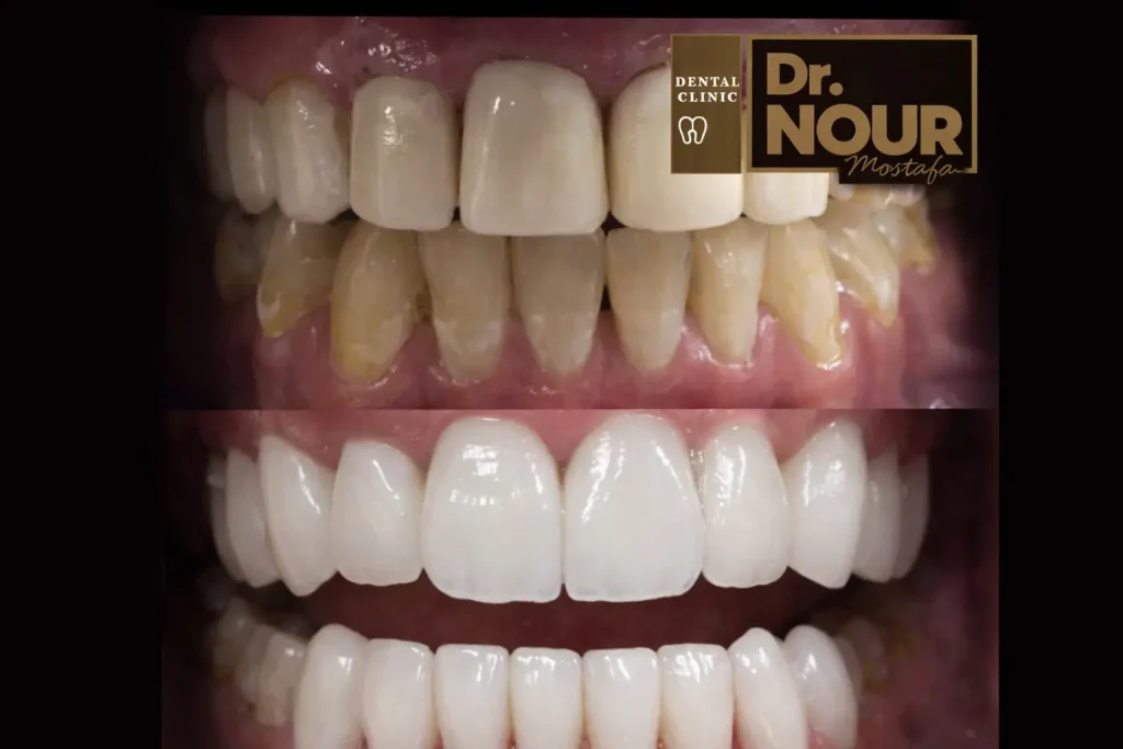 صور تجميل اسنان قبل وبعد