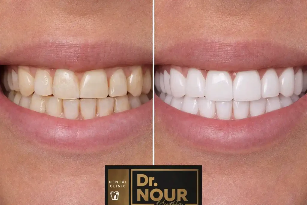 فينير الأسنان قبل وبعد
