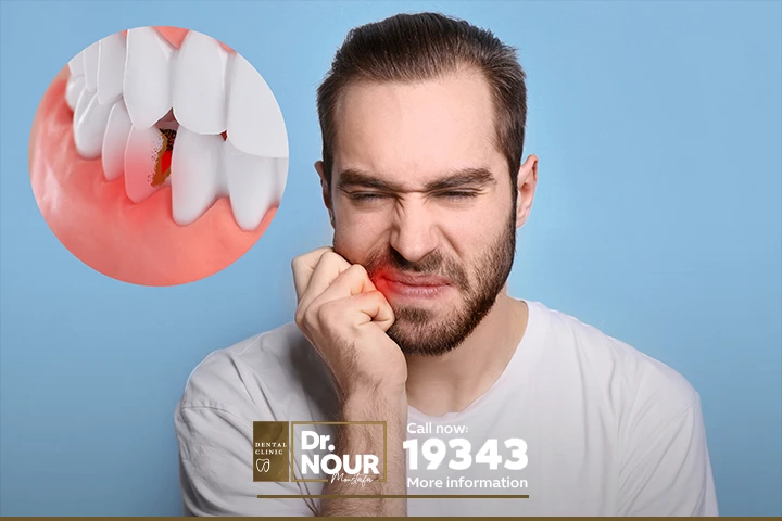 التهاب اللثه حول الضرس