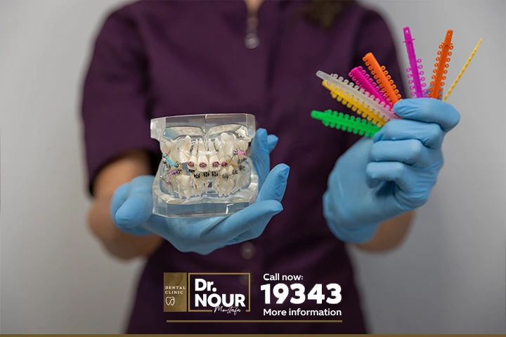 تقويم الاسنان المتحرك